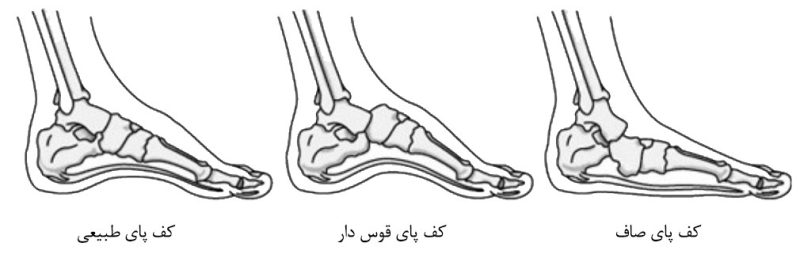 کفش طبی چرم طبیعی و قوس کف پا